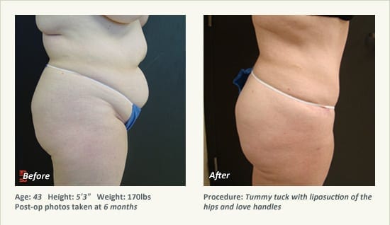Abdominoplastia en Plano, TX - Patient 26