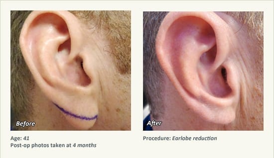 Earlobe Surgery in Plano, TX - Patient 85