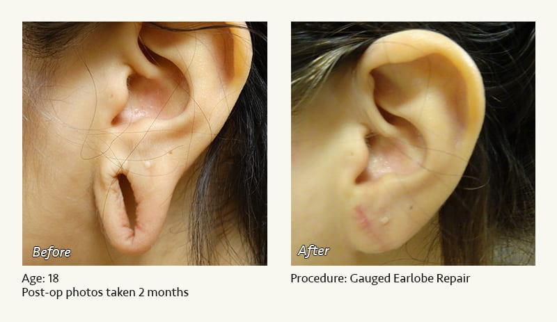Earlobe Surgery in Plano, TX - Patient 70