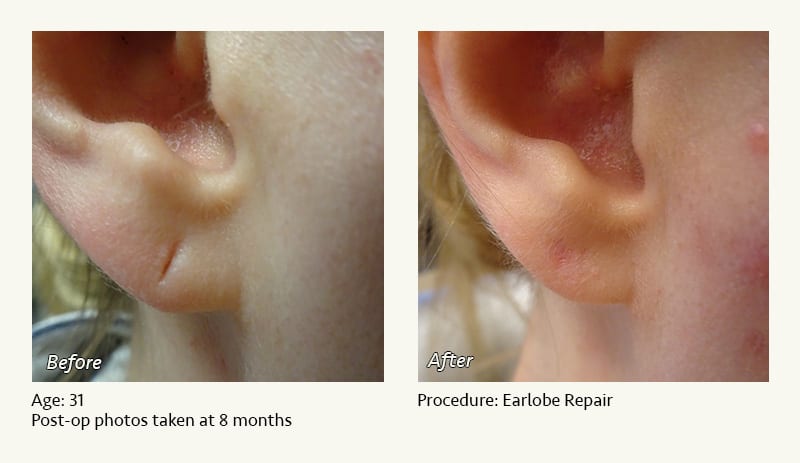 Earlobe Surgery in Plano, TX - Patient 69