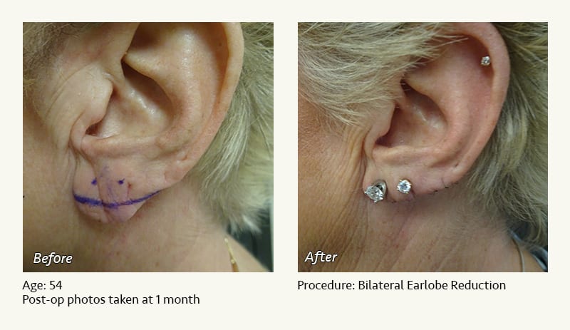 Earlobe Surgery in Plano, TX - Patient 76