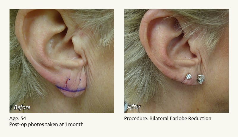 Earlobe Surgery in Plano, TX - Patient 77