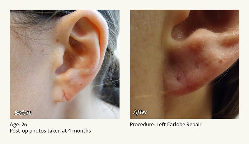 Earlobe Surgery in Plano, TX - Patient 80