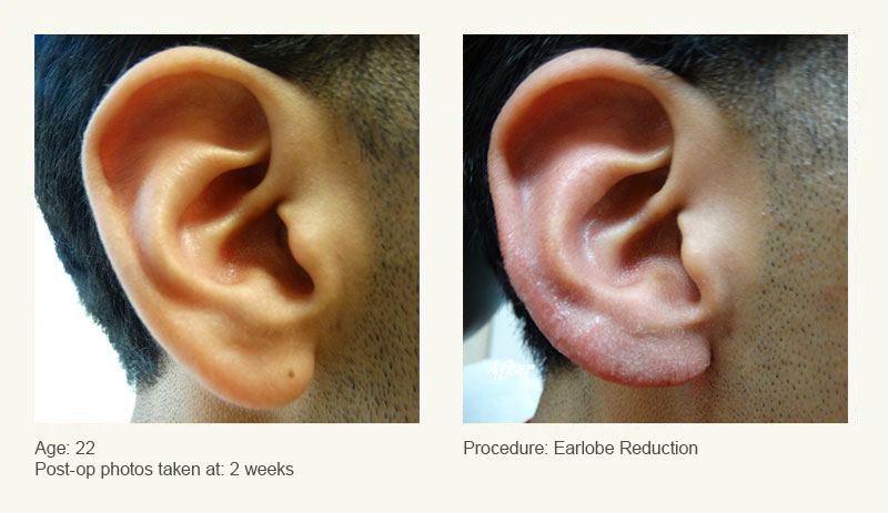 Earlobe Surgery in Plano, TX - Patient 4