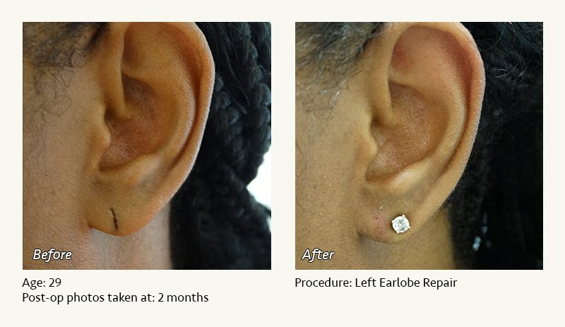 Earlobe Surgery in Plano, TX - Patient 18