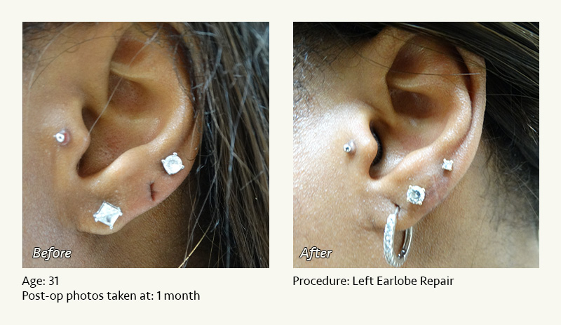 Earlobe Surgery in Plano, TX - Patient 7