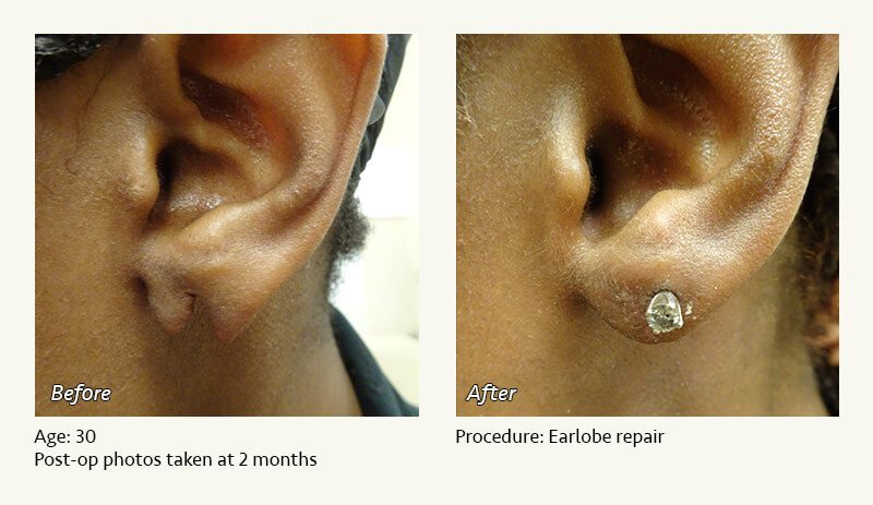 Earlobe Surgery in Plano, TX - Patient 59