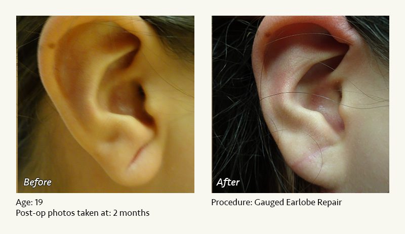 Earlobe Surgery in Plano, TX - Patient 58