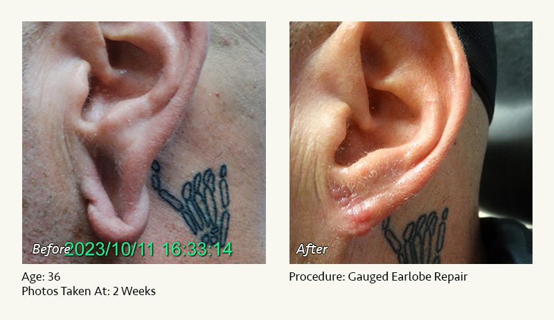 Earlobe Surgery in Plano, TX - Patient 41