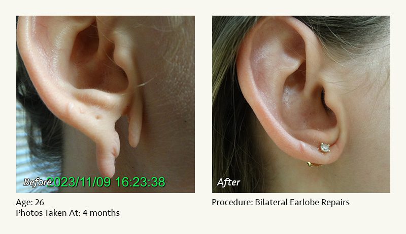 Earlobe Surgery in Plano, TX - Patient 33