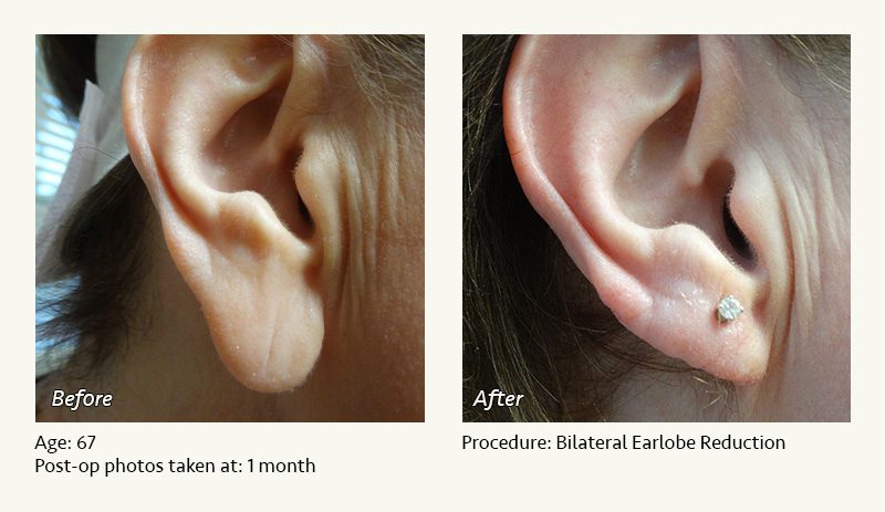 Earlobe Surgery in Plano, TX - Patient 29
