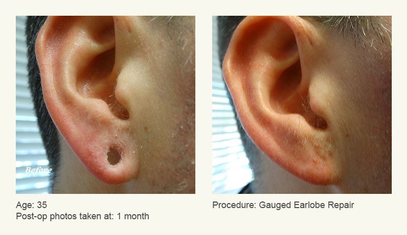 Earlobe Surgery in Plano, TX - Patient 22