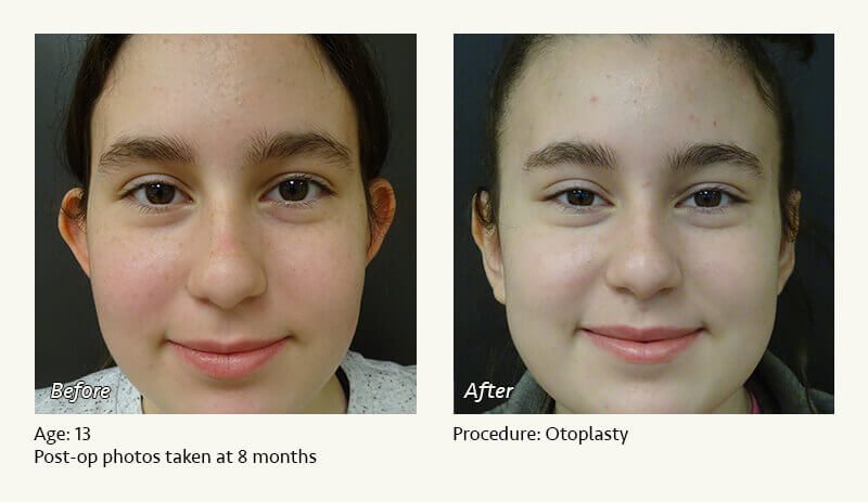 Otoplasty | Ear Pinning Surgery in Plano, TX - Patient 7