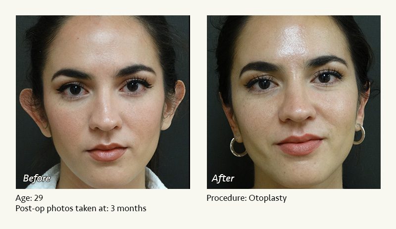 Otoplasty | Ear Pinning Surgery in Plano, TX - Patient 5