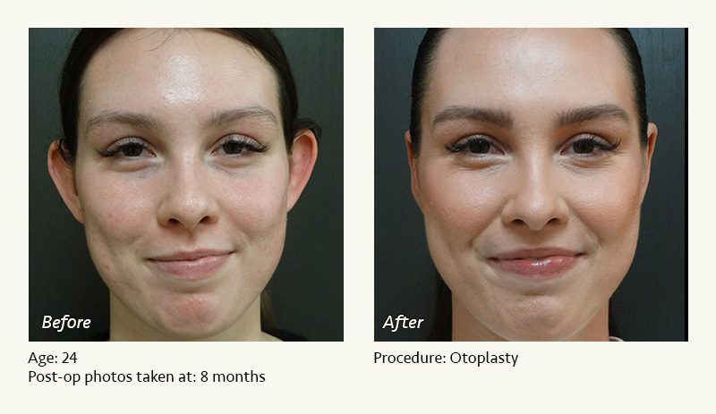 Otoplasty | Ear Pinning Surgery in Plano, TX - Patient 1