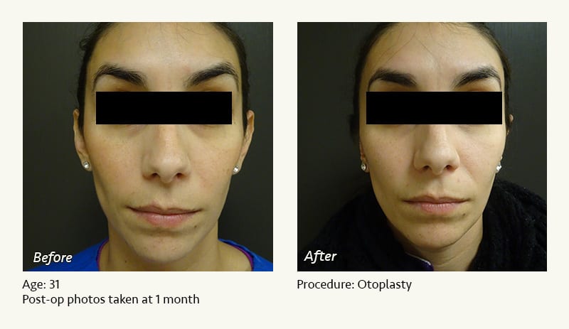Otoplasty | Ear Pinning Surgery in Plano, TX - Patient 16