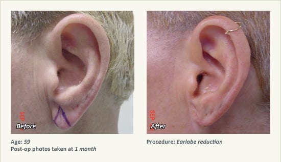 Earlobe Surgery in Plano, TX - Patient 90