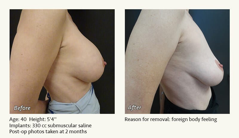 Breast Implant Removal - Patient 16