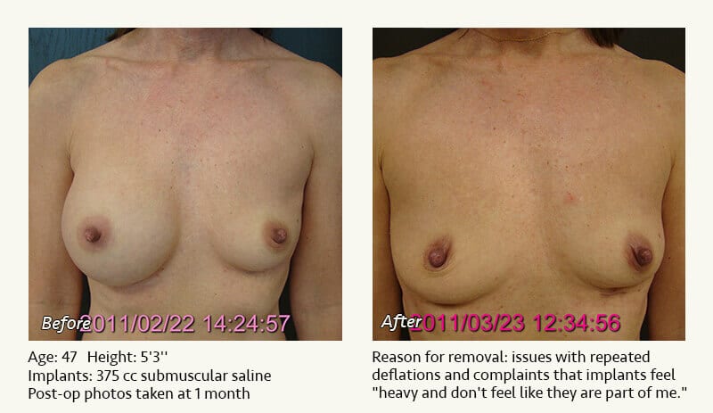 Breast Implant Removal - Patient 17