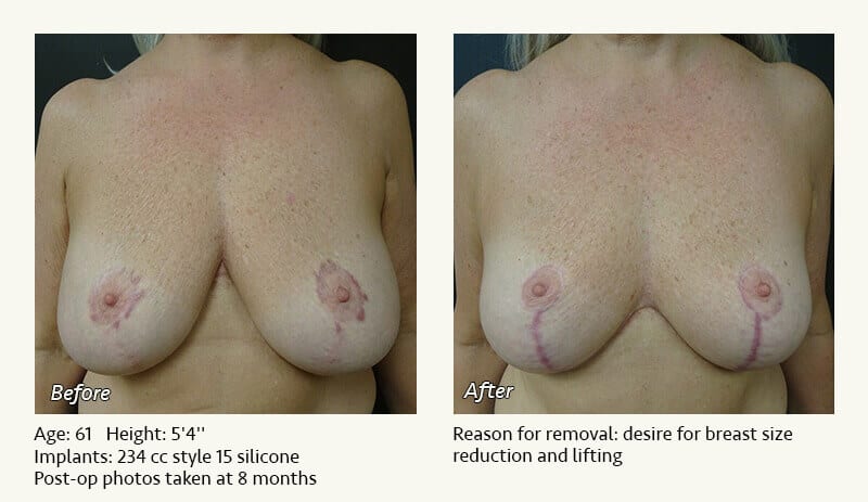 Breast Implant Removal - Patient 23