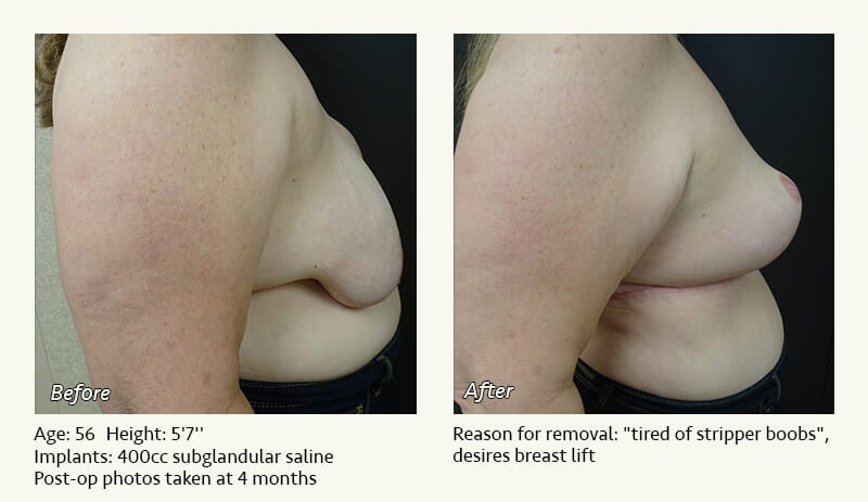 Breast Implant Removal - Patient 12
