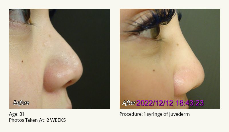 Nonsurgical Rhinoplasty in Plano & Dallas, TX - Patient 7