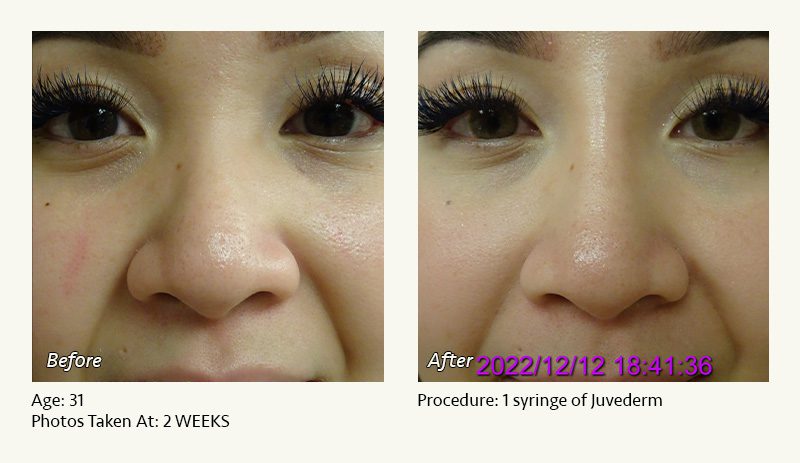 Nonsurgical Rhinoplasty in Plano & Dallas, TX - Patient 6