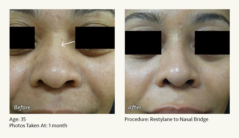 Nonsurgical Rhinoplasty in Plano & Dallas, TX - Patient 5