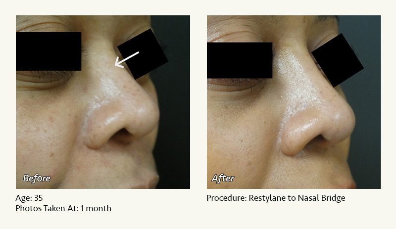 Nonsurgical Rhinoplasty in Plano & Dallas, TX - Patient 4