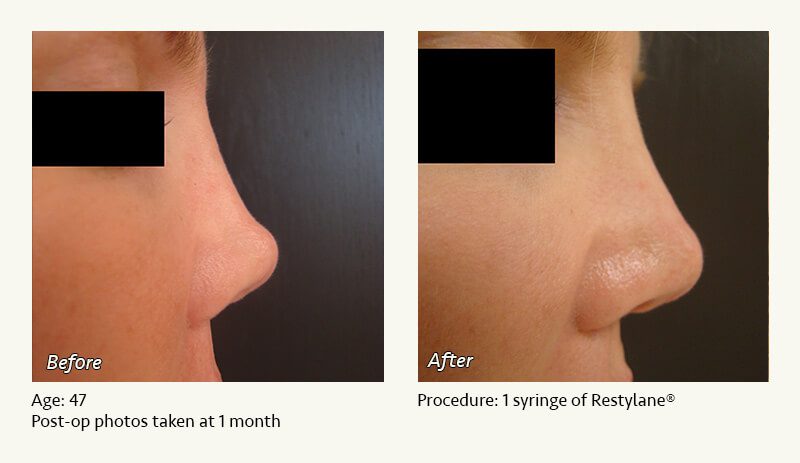 Nonsurgical Rhinoplasty in Plano & Dallas, TX - Patient 10