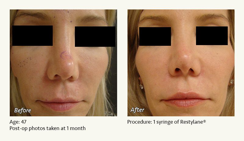Nonsurgical Rhinoplasty in Plano & Dallas, TX - Patient 9
