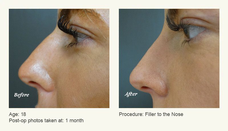 Nonsurgical Rhinoplasty in Plano & Dallas, TX - Patient 3