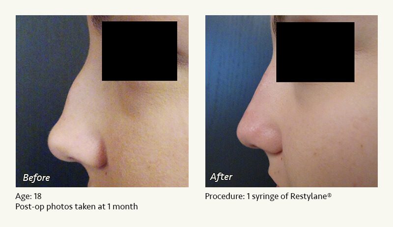 Nonsurgical Rhinoplasty in Plano & Dallas, TX - Patient 12