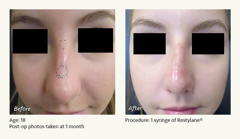 Nonsurgical Rhinoplasty in Plano & Dallas, TX - Patient 11
