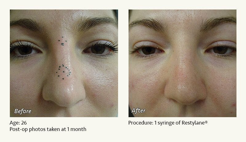 Nonsurgical Rhinoplasty in Plano & Dallas, TX - Patient 13