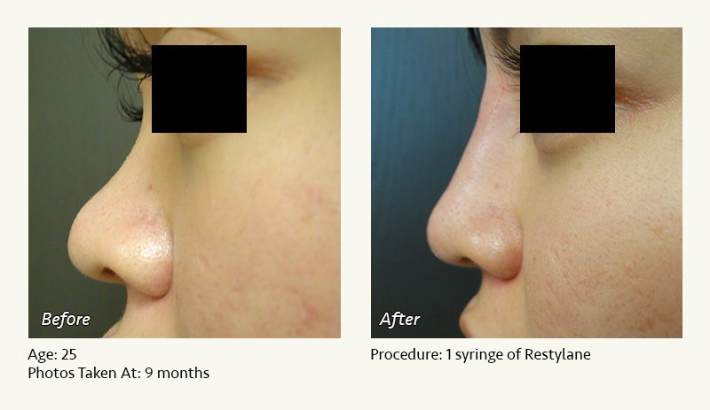 Nonsurgical Rhinoplasty in Plano & Dallas, TX - Patient 8