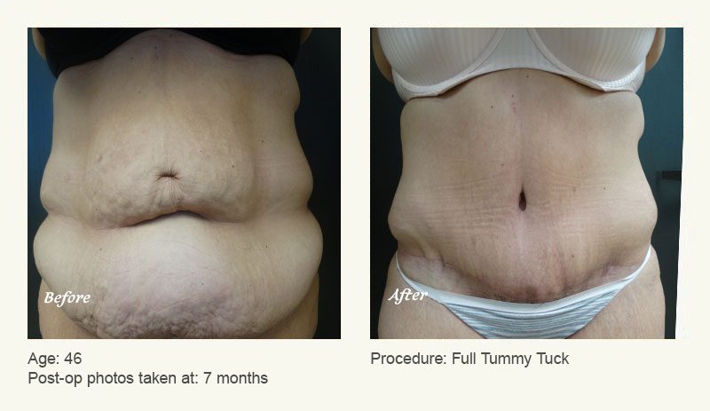 Tummy Tuck in Plano, TX - Patient 11